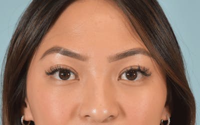Blepharoplasty Before & After Gallery - Patient 177762 - Image 2