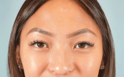 Blepharoplasty Before & After Gallery - Patient 177762 - Image 1