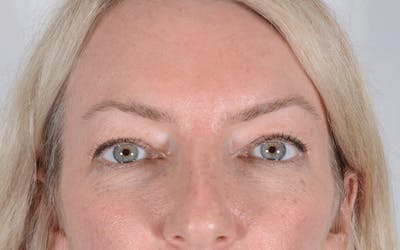 Blepharoplasty Before & After Gallery - Patient 139740 - Image 1