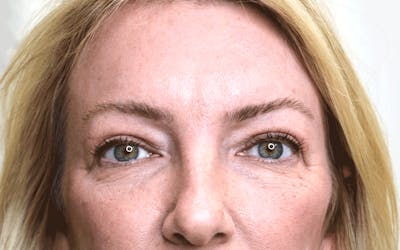 Blepharoplasty Before & After Gallery - Patient 139740 - Image 2
