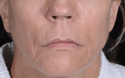 Lip Lift Before & After Gallery - Patient 188559 - Image 1