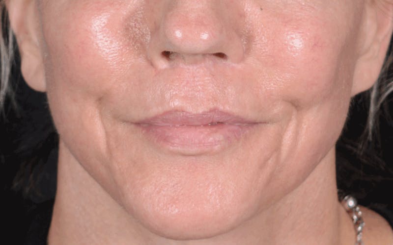 Lip Lift Before & After Gallery - Patient 188559 - Image 2