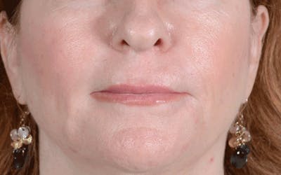 Lip Lift Before & After Gallery - Patient 139209 - Image 1