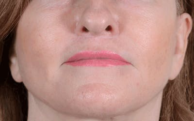 Lip Lift Before & After Gallery - Patient 139209 - Image 2