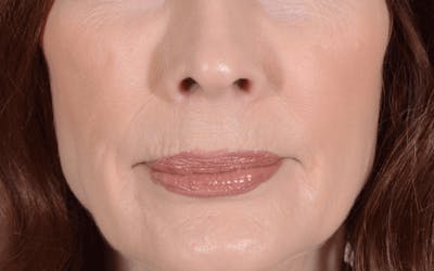 Lip Lift Before & After Gallery - Patient 320524 - Image 1