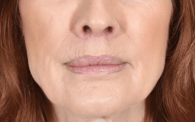 Lip Lift Before & After Gallery - Patient 320524 - Image 2