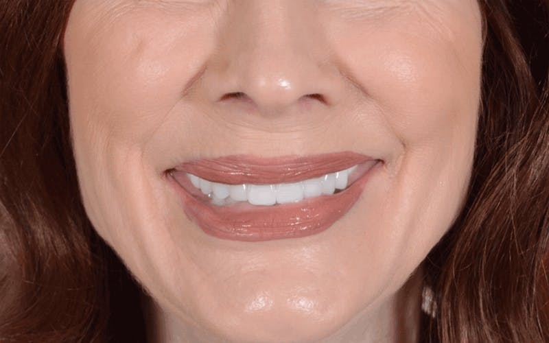 Lip Lift Before & After Gallery - Patient 320524 - Image 3