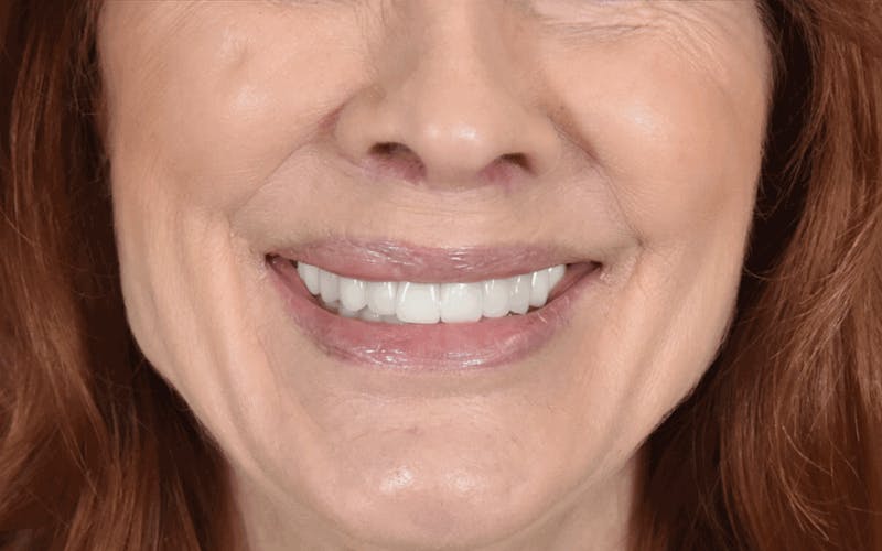 Lip Lift Before & After Gallery - Patient 320524 - Image 4