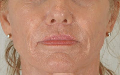Lip Lift Before & After Gallery - Patient 211976 - Image 2