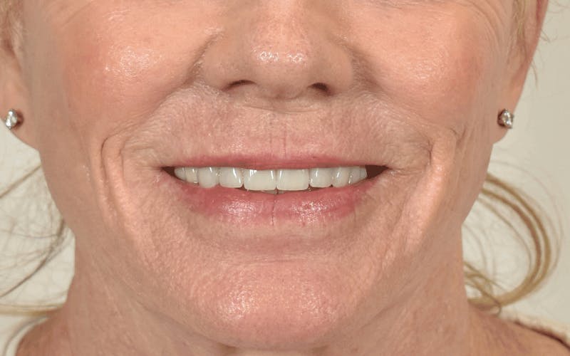 Lip Lift Before & After Gallery - Patient 211976 - Image 3