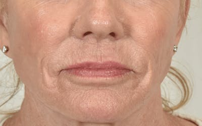 Lip Lift Before & After Gallery - Patient 211976 - Image 1