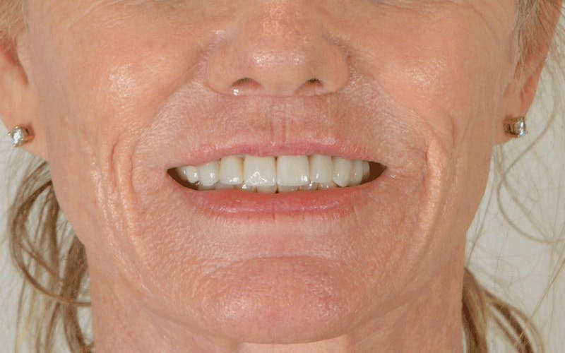 Lip Lift Before & After Gallery - Patient 211976 - Image 4