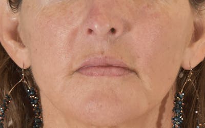 Lip Lift Before & After Gallery - Patient 266309 - Image 2