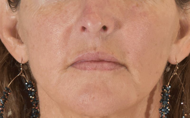 Lip Lift Before & After Gallery - Patient 266309 - Image 2