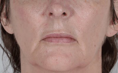 Lip Lift Before & After Gallery - Patient 266309 - Image 1