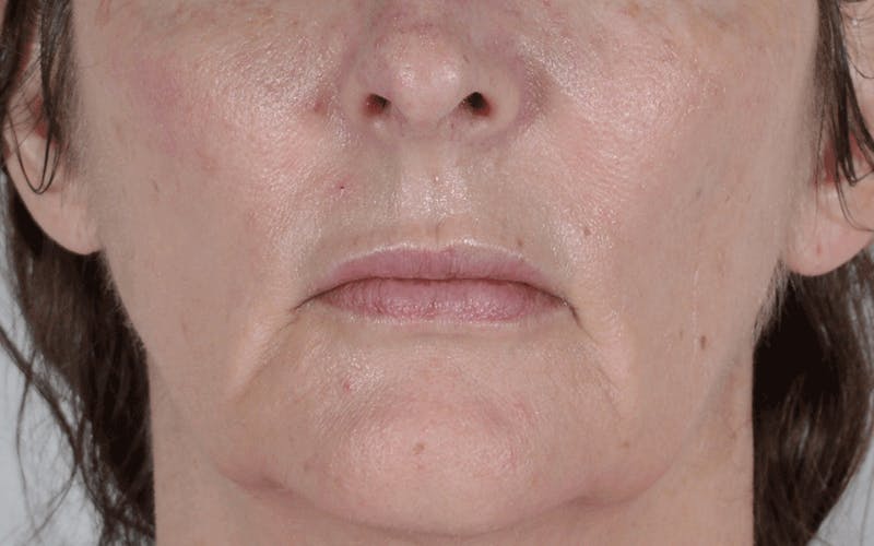 Lip Lift Before & After Gallery - Patient 266309 - Image 1