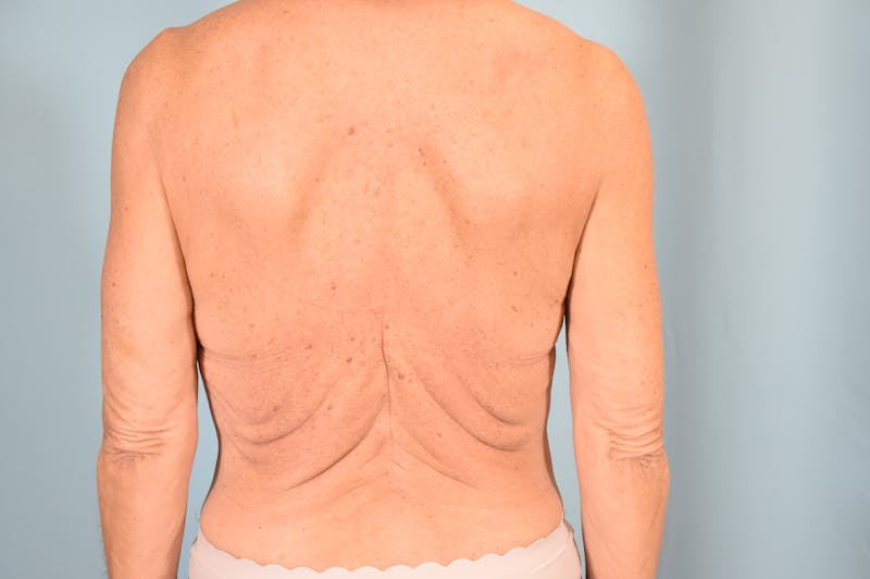Bra Line Backlift Before & After Gallery - Patient 104991 - Image 3