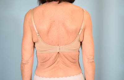 Bra Line Backlift Before & After Gallery - Patient 104991 - Image 1
