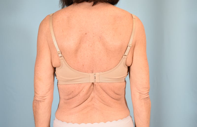 Bra Line Backlift Before & After Gallery - Patient 104991 - Image 1