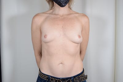 Breast Augmentation Before & After Gallery - Patient 117437 - Image 1