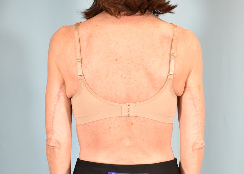 Bra Line Backlift Before & After Gallery - Patient 104991 - Image 2