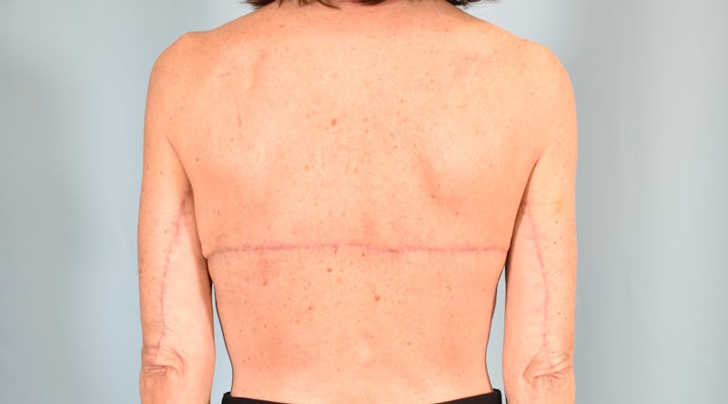 Bra Line Backlift Before & After Gallery - Patient 104991 - Image 4