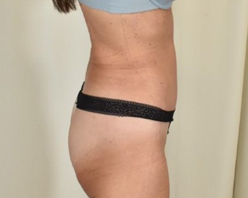 Tummy Tuck Before & After Gallery - Patient 365822 - Image 6