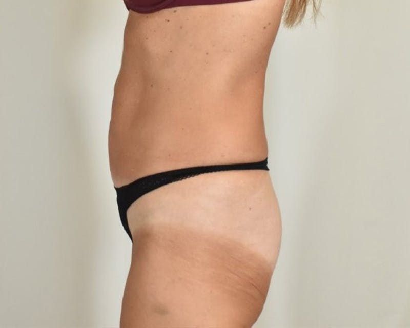 Tummy Tuck Before & After Gallery - Patient 365822 - Image 9