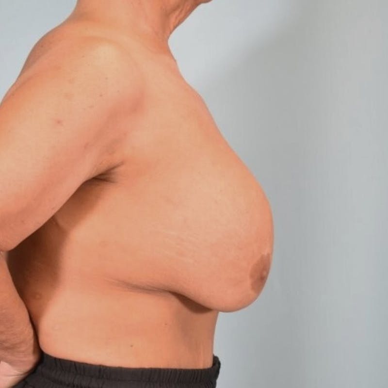Breast Implant Revision Before & After Gallery - Patient 274823 - Image 10