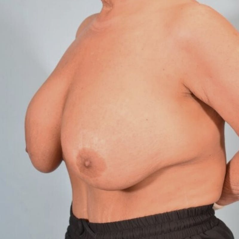 Breast Implant Revision Before & After Gallery - Patient 274823 - Image 3