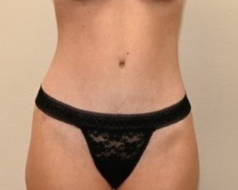 Tummy Tuck Before & After Gallery - Patient 225651 - Image 2