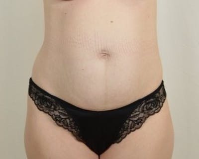 Tummy Tuck Before & After Gallery - Patient 225651 - Image 1