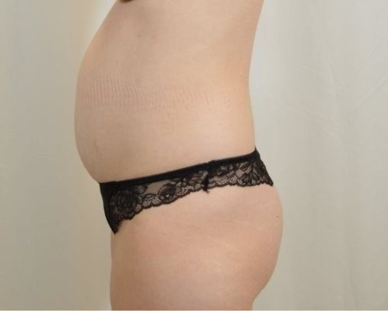 Tummy Tuck Before & After Gallery - Patient 225651 - Image 3