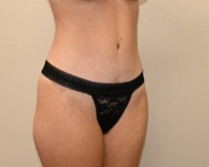 Tummy Tuck Before & After Gallery - Patient 225651 - Image 8