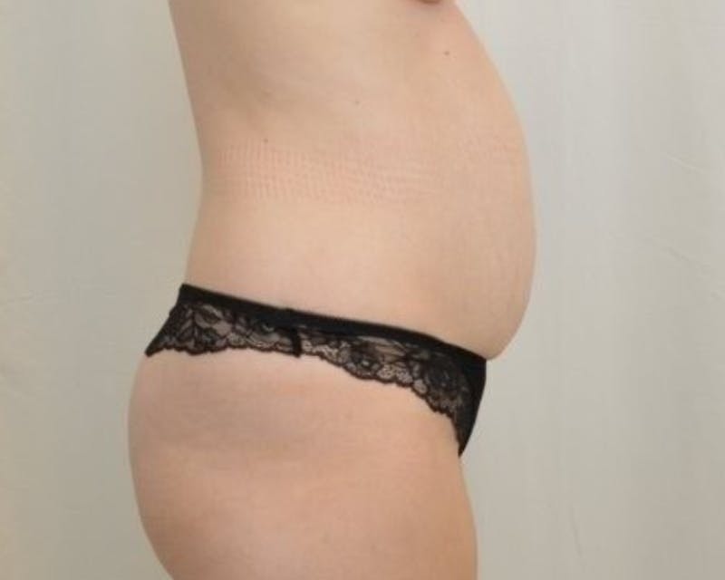 Tummy Tuck Before & After Gallery - Patient 225651 - Image 9