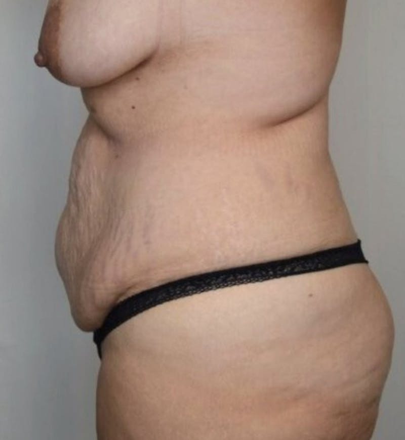 Body Lift Before & After Gallery - Patient 305976 - Image 3