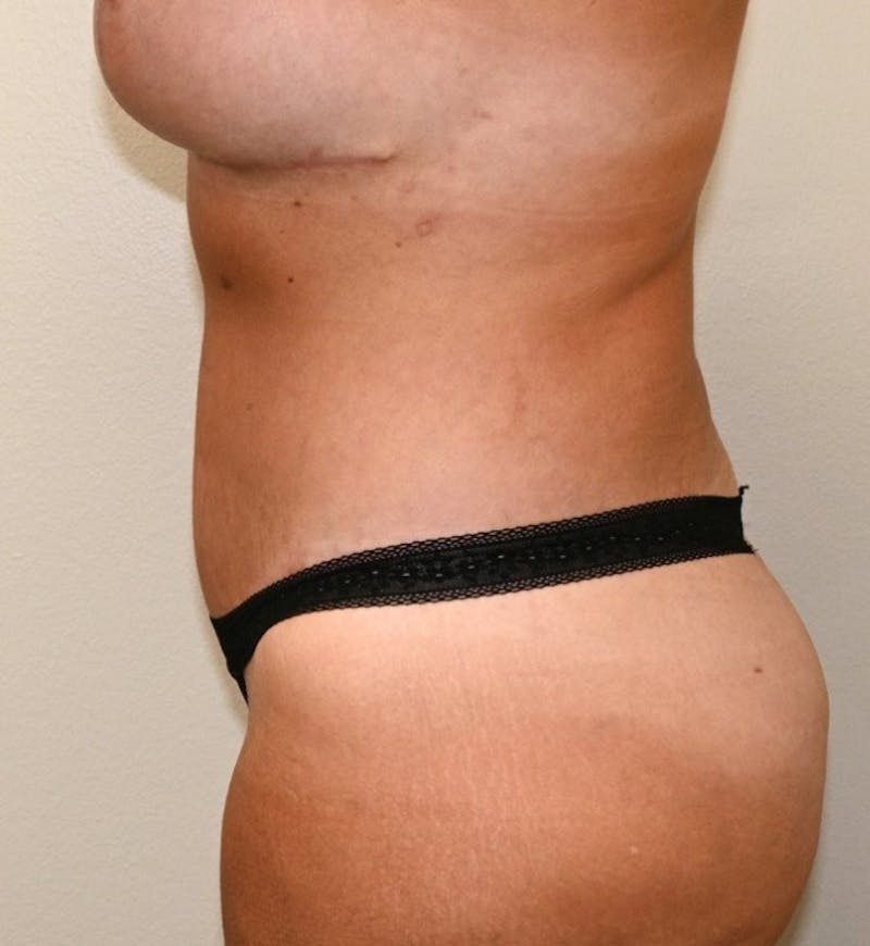 Body Lift Before & After Gallery - Patient 305976 - Image 4