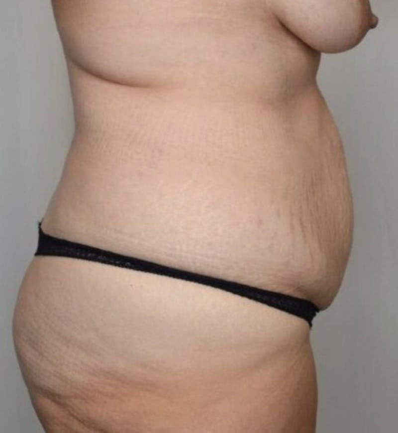 Body Lift Before & After Gallery - Patient 305976 - Image 5