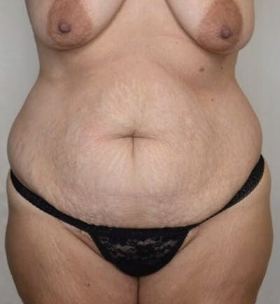 Body Lift Before & After Gallery - Patient 305976 - Image 1
