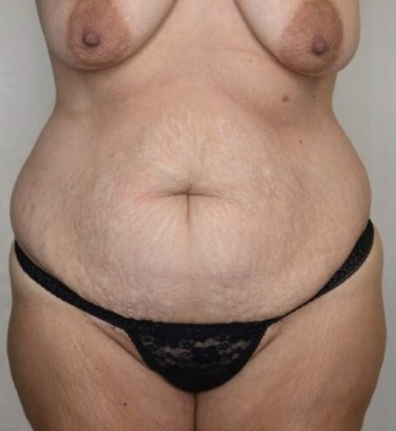 Body Lift Before & After Gallery - Patient 305976 - Image 1