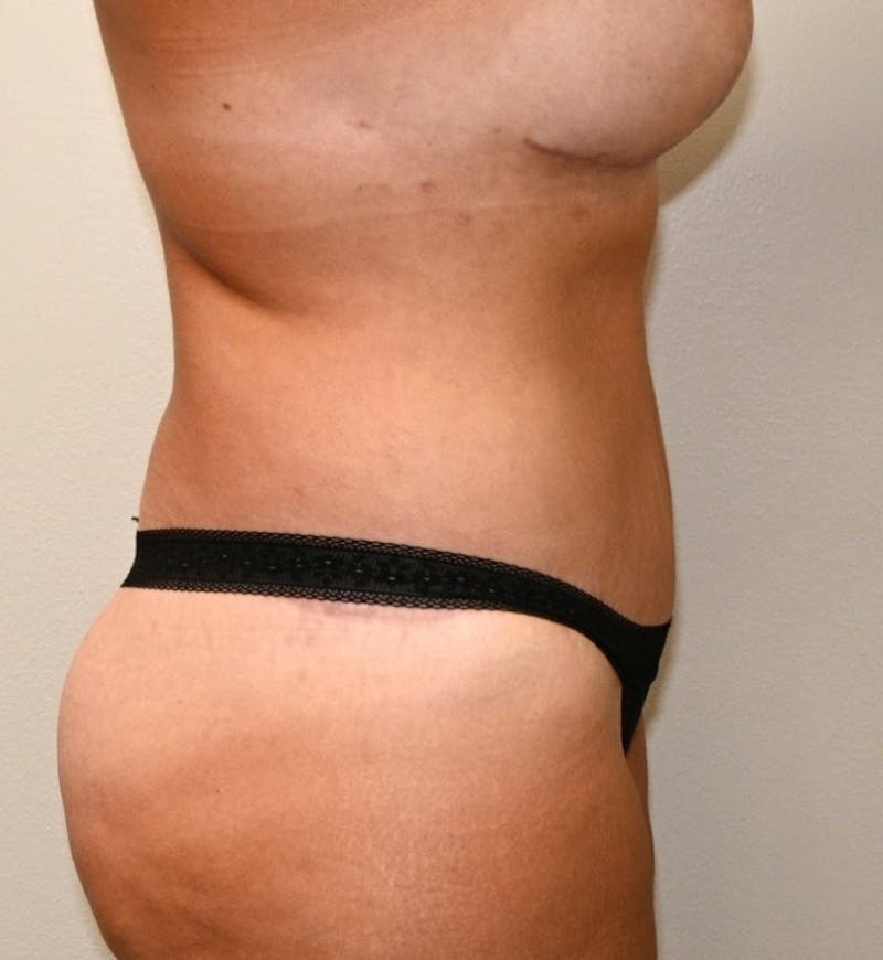 Body Lift Before & After Gallery - Patient 305976 - Image 6