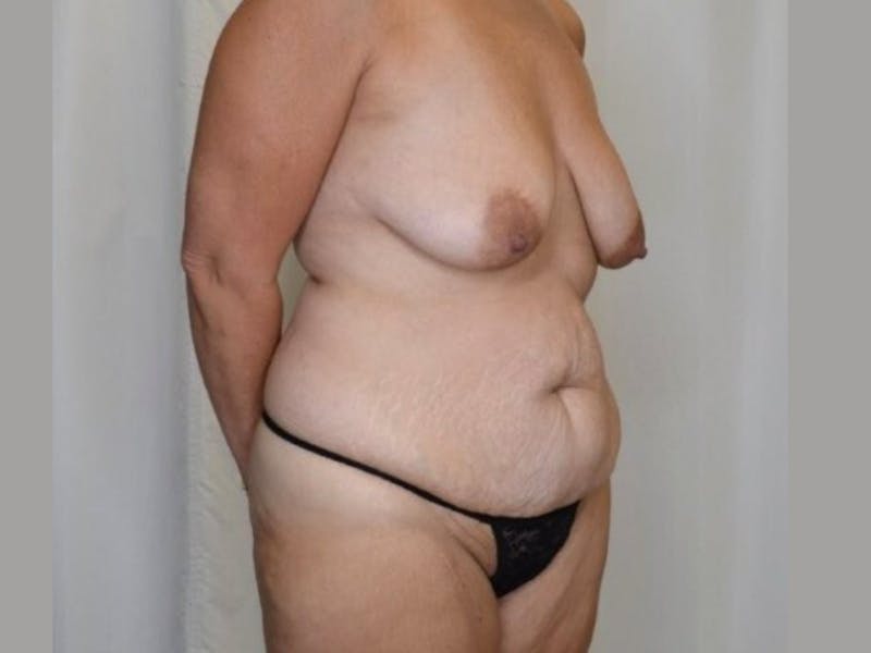 Mommy Makeover Before & After Gallery - Patient 208941 - Image 5