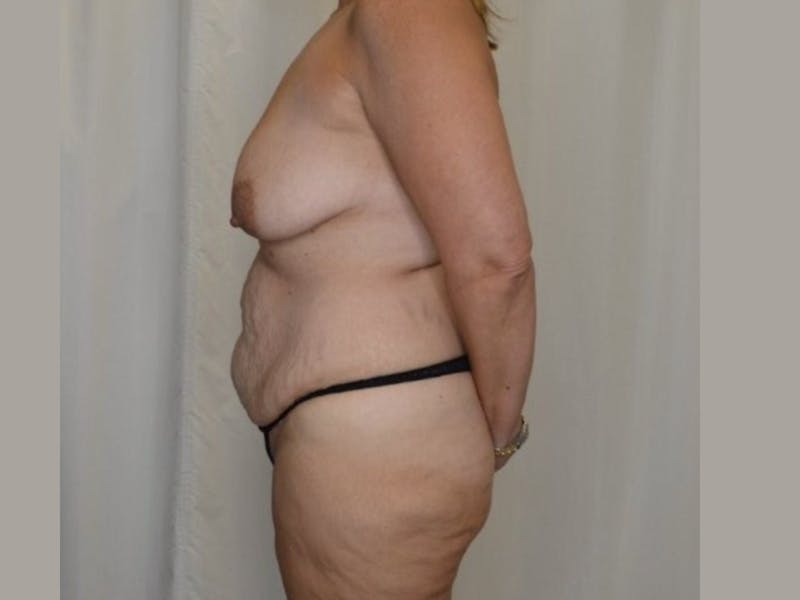 Mommy Makeover Before & After Gallery - Patient 208941 - Image 7