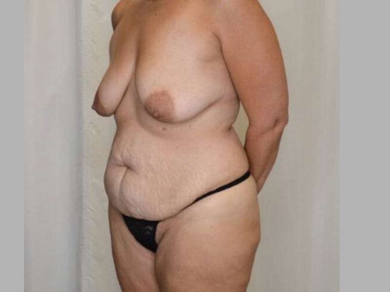 Mommy Makeover Before & After Gallery - Patient 208941 - Image 3