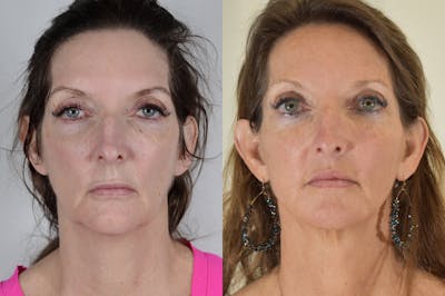 Facelift Before & After Gallery - Patient 854927 - Image 1