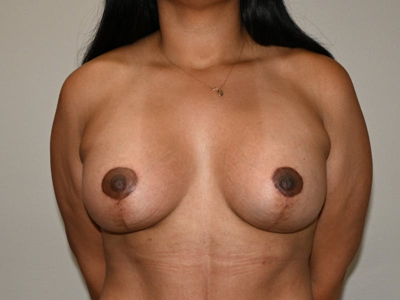 Breast Lift With Implant Before & After Gallery - Patient 276432 - Image 2
