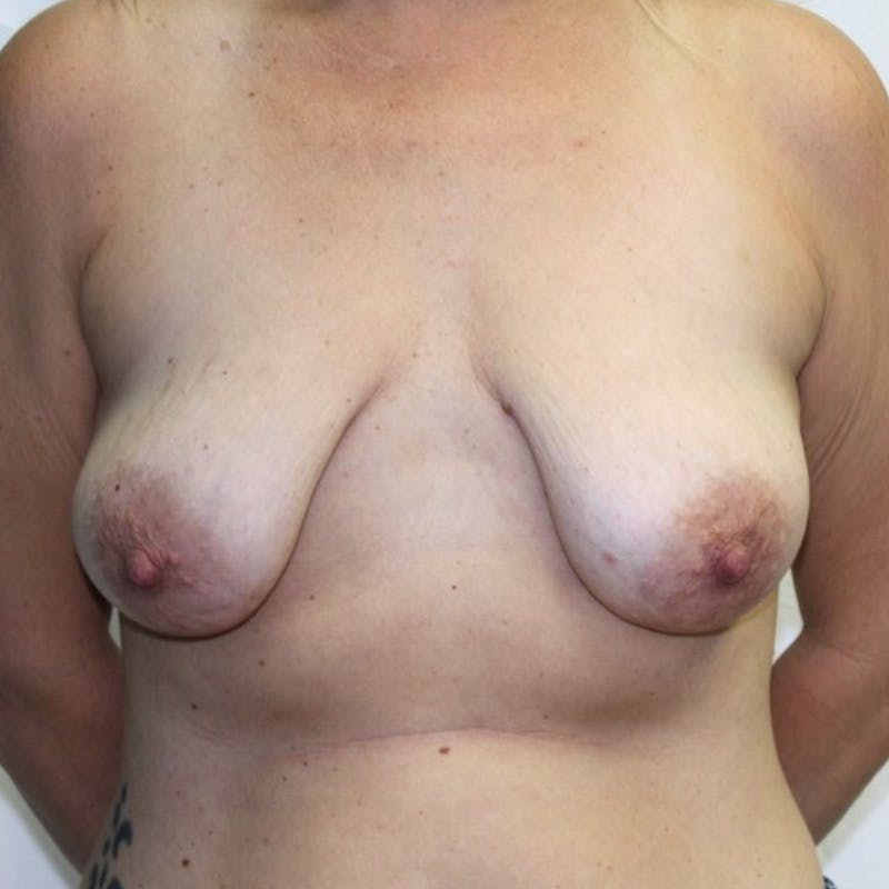 Mastopexy Before & After Gallery - Patient 213722 - Image 1