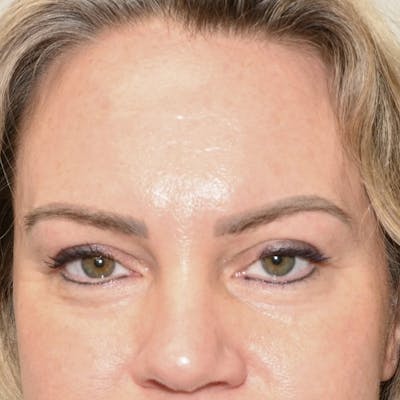 Blepharoplasty Before & After Gallery - Patient 242864 - Image 2