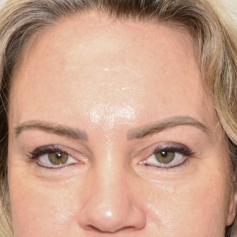 Blepharoplasty Before & After Gallery - Patient 242864 - Image 2