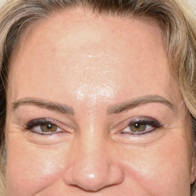 Blepharoplasty Before & After Gallery - Patient 242864 - Image 4